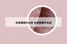 頭皮癬掛什么科 頭皮癬看什么科