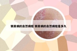 銀屑病的自然病程 銀屑病的自然病程是多久