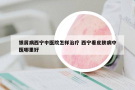 銀屑病西寧中醫(yī)院怎樣治療 西寧看皮膚病中醫(yī)哪里好