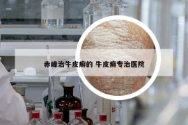 赤峰治牛皮癬的 牛皮癬專治醫(yī)院