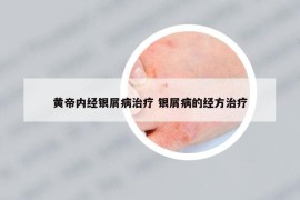 黃帝內(nèi)經(jīng)銀屑病治療 銀屑病的經(jīng)方治療