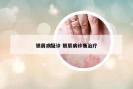 銀屑病疑診 銀屑病診斷治療