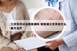 三伏天可以治銀屑病嗎 銀屑病三伏天有什么偏方治療