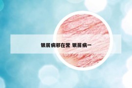 銀屑病邪在營(yíng) 銀屑病一