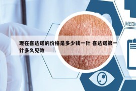 現(xiàn)在喜達(dá)諾的價格是多少錢一針 喜達(dá)諾第一針多久見效