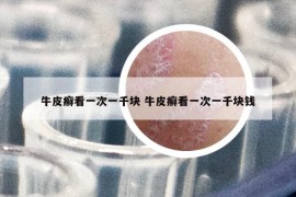 牛皮癬看一次一千塊 牛皮癬看一次一千塊錢