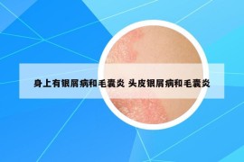 身上有銀屑病和毛囊炎 頭皮銀屑病和毛囊炎