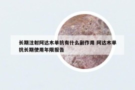 長(zhǎng)期注射阿達(dá)木單抗有什么副作用 阿達(dá)木單抗長(zhǎng)期使用年限報(bào)告