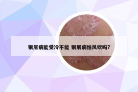 銀屑病能受冷不能 銀屑病怕風(fēng)吹嗎?