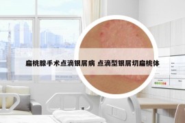 扁桃腺手術(shù)點(diǎn)滴銀屑病 點(diǎn)滴型銀屑切扁桃體