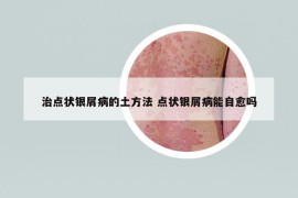 治點(diǎn)狀銀屑病的土方法 點(diǎn)狀銀屑病能自愈嗎