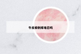 牛皮癬刺癢難忍嗎