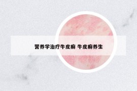 營(yíng)養(yǎng)學(xué)治療牛皮癬 牛皮癬養(yǎng)生