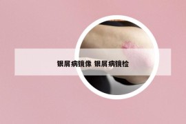 銀屑病鏡像 銀屑病鏡檢
