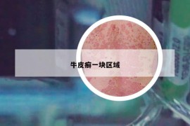 牛皮癬一塊區(qū)域