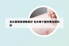 包頭看銀屑病哪里好 包頭哪個(gè)醫(yī)院看皮膚科好