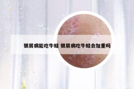 銀屑病能吃牛蛙 銀屑病吃牛蛙會(huì)加重嗎