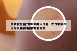 生物制劑治療銀屑病幾天注射一次 生物制劑治療銀屑病的副作用有哪些