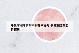 半夏專治牛皮癬頭癬特效秘方 半夏治脫發(fā)怎樣使用