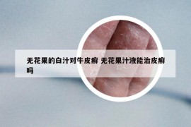 無(wú)花果的白汁對(duì)牛皮癬 無(wú)花果汁液能治皮癬嗎