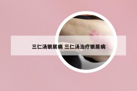 三仁湯銀屑病 三仁湯治療銀屑病