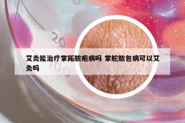 艾灸能治療掌跖膿皰病嗎 掌舵膿包病可以艾灸嗎