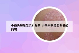 小孩頭癬是怎么引起的 小孩頭癬是怎么引起的呢