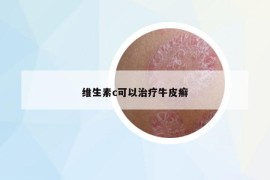 維生素c可以治療牛皮癬