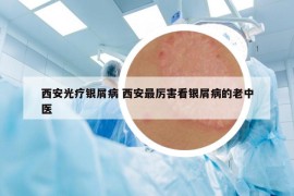 西安光療銀屑病 西安最厲害看銀屑病的老中醫(yī)