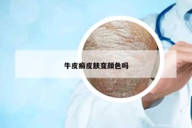 牛皮癬皮膚變顏色嗎