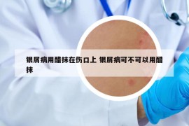 銀屑病用醋抹在傷口上 銀屑病可不可以用醋抹