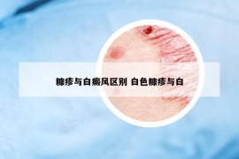 糠疹與白癜風(fēng)區(qū)別 白色糠疹與白