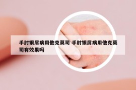 手肘銀屑病用他克莫司 手肘銀屑病用他克莫司有效果嗎