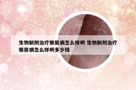 生物制劑治療銀屑病怎么樣啊 生物制劑治療銀屑病怎么樣啊多少錢