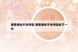 銀屑病會不會傳染 銀屑病會不會傳染給下一代