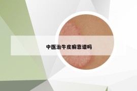 中醫(yī)治牛皮癬靠譜嗎
