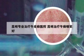 昆明專業(yè)治療牛皮癬醫(yī)院 昆明治療牛癬哪家好