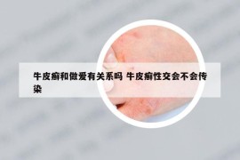 牛皮癬和做愛有關(guān)系嗎 牛皮癬性交會不會傳染
