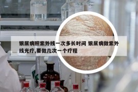 銀屑病照紫外線一次多長(zhǎng)時(shí)間 銀屑病做紫外線光療,要做幾次一個(gè)療程