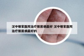 漢中哪家醫(yī)院治療銀屑病最好 漢中哪家醫(yī)院治療銀屑病最好的