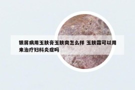 銀屑病用玉膚膏玉膚爽怎么樣 玉膚霜可以用來治療婦科炎癥嗎