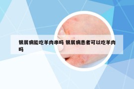 銀屑病能吃羊肉串嗎 銀屑病患者可以吃羊肉嗎