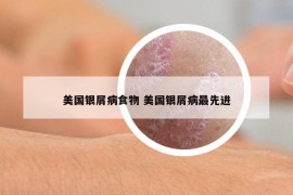 美國銀屑病食物 美國銀屑病最先進