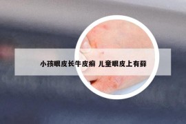 小孩眼皮長牛皮癬 兒童眼皮上有蘚