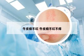 牛皮癬不紅 牛皮癬不紅不癢