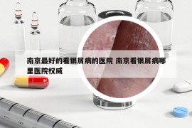 南京最好的看銀屑病的醫(yī)院 南京看銀屑病哪里醫(yī)院權(quán)威