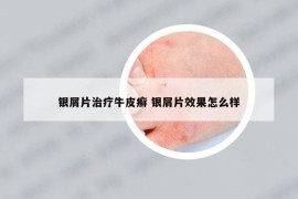 銀屑片治療牛皮癬 銀屑片效果怎么樣