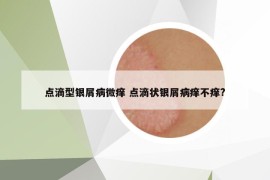 點(diǎn)滴型銀屑病微癢 點(diǎn)滴狀銀屑病癢不癢?