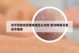 關(guān)節(jié)型膿包型銀屑病怎么住院 膿泡銀屑又是關(guān)節(jié)銀屑