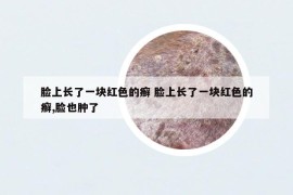 臉上長(zhǎng)了一塊紅色的癬 臉上長(zhǎng)了一塊紅色的癬,臉也腫了